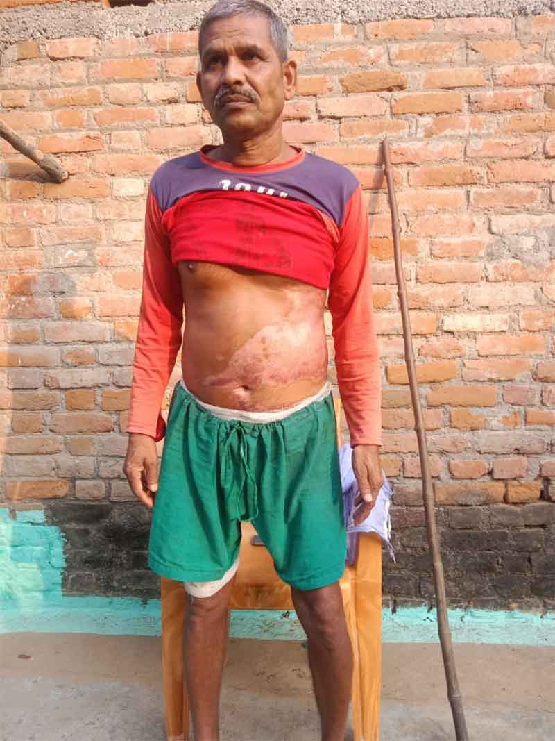 Dalit-attacked-with-boiling-water