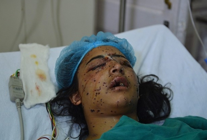 kashmir-pellet-injury