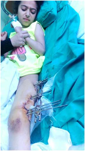 This young lady, ten year old Ghina, now recovering in Damascus, was shot nearly two months ago by a sniper in the besieged town of Madaya. The sniper used International Humanitarian Law (Rome Statute) prohibited bullets "which expand and flatten inside the human body.” Photo: Franklin Lamb 9/3/2016
