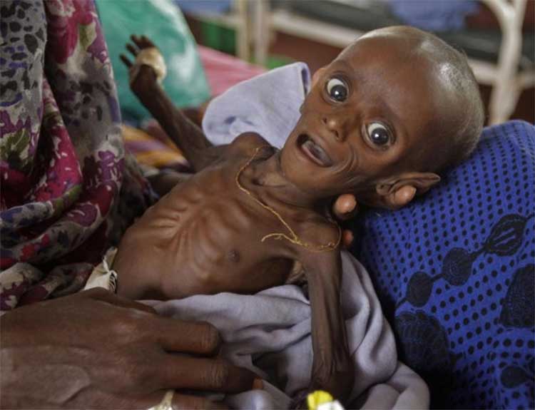 starvation-somalia