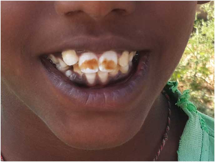 fluorosis-teeth