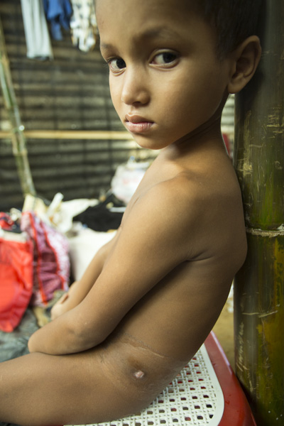 Rohingya Refugee Child who was shot in Myanmar. At Balukhali near Bangladesh-Myanmar border, Ukhia, Cox's Bazar, Bangladesh. Photo: © Abu Ala