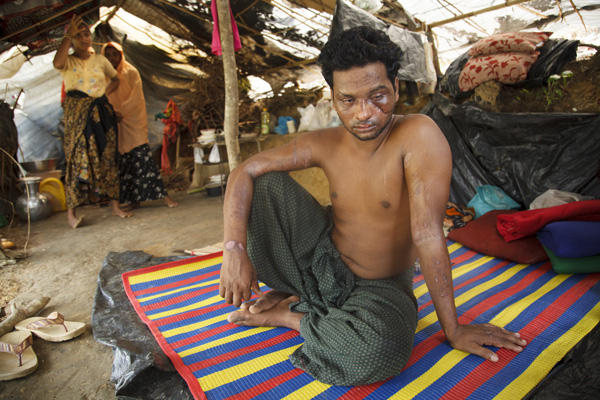 Rohingya Refugee injured by Burmese mob on the way to Bangladesh, at No-man's land in Bangladesh-Myanmar border, Bangladesh. Photo: © Abu Ala
