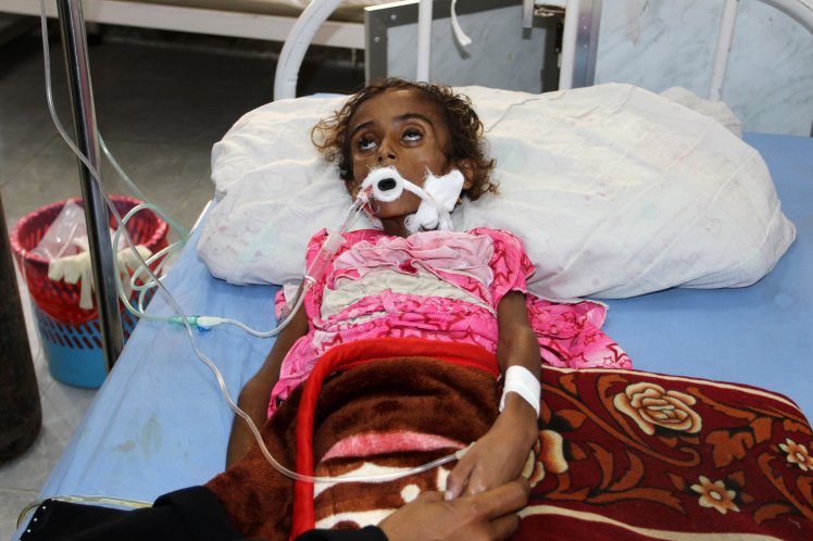 (FILES) This file photo taken on May 02, 2017 shows a malnourished Yemeni child receiving treatment at a hospital in the Yemeni port city of Hodeidah.  / AFP PHOTO / STRSTR/AFP/Getty Images