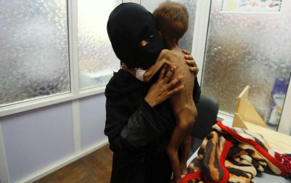 yemen starving child4