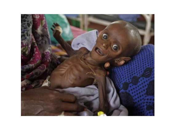 starving child somalia
